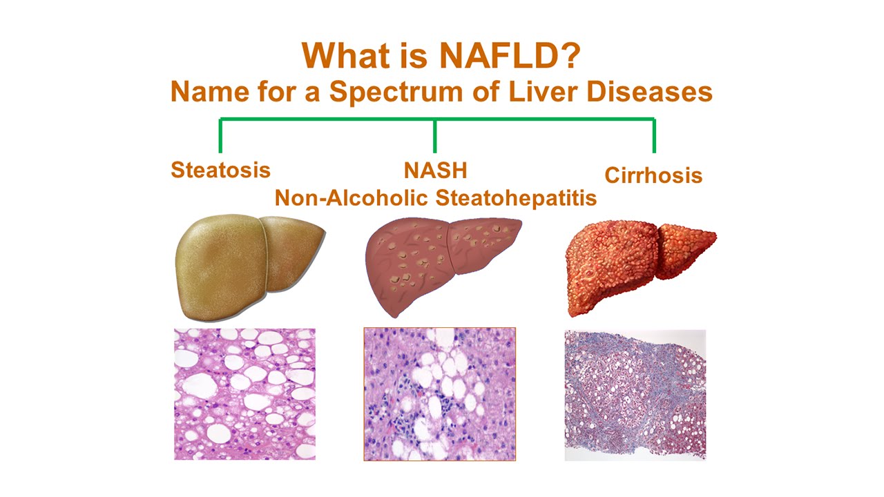 Non-Alcoholic Fatty Liver Diseases (NAFLD) "EMPOWER IAS"