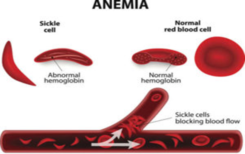 NATIONAL SICKLE CELL ANAEMIA ELIMINATION MISSION | L2A Learn to Achieve