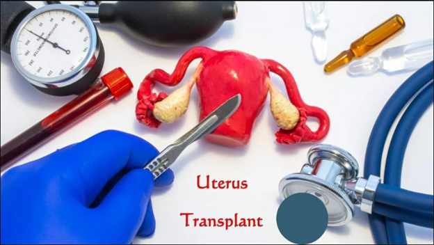 img-Uterus Transplantation
