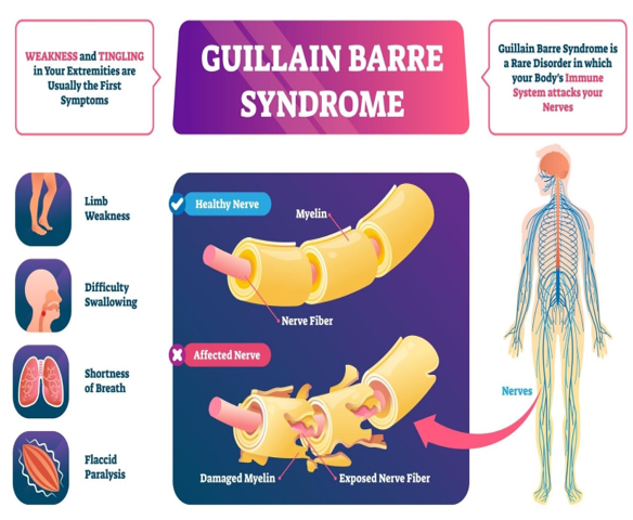 Guillain-Barre Syndrome